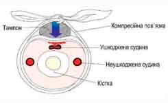 Як зупинити кров. Як спинити сильну кровотечу.